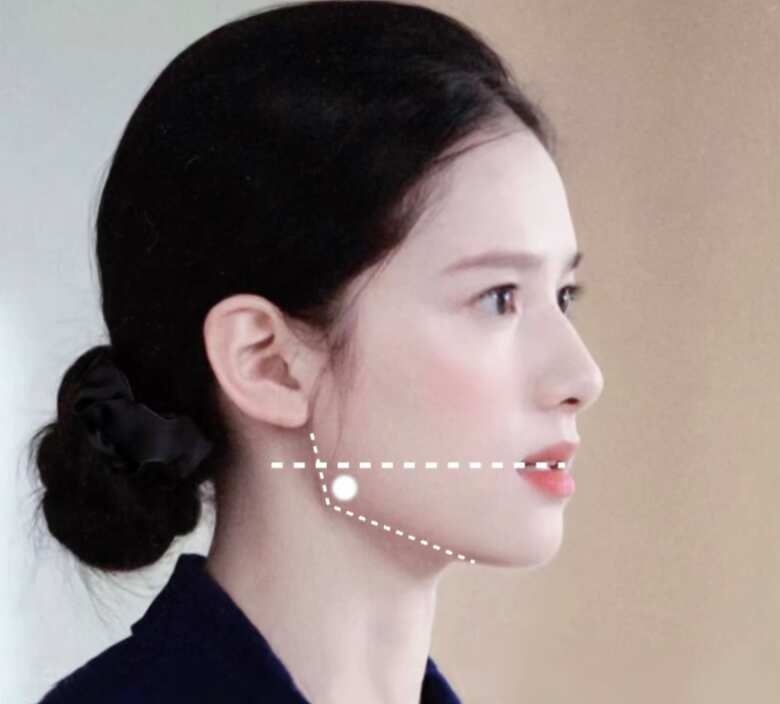 你可能不是真的方圆脸！！！
侧面下颌拐点又低又方就是方圆脸？完全错！！！
张婧仪呢就是很标准的拐点方且低于嘴角的，迪丽热巴的拐点也是靠下的正面看她的脸完全不方啊。所以决定你脸方脸宽的是你的下颌骨架大小，不是看侧面的下颌拐点的高低。当下颌的骨架夹角大于等于90度正面看脸会宽大。重点很多人的咬肌都很肥厚