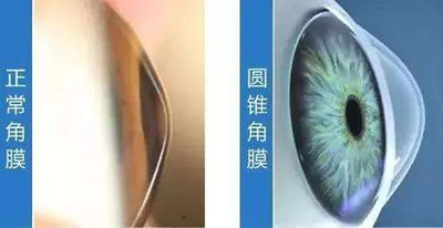 “为什么偏偏是我患上圆锥角膜？”