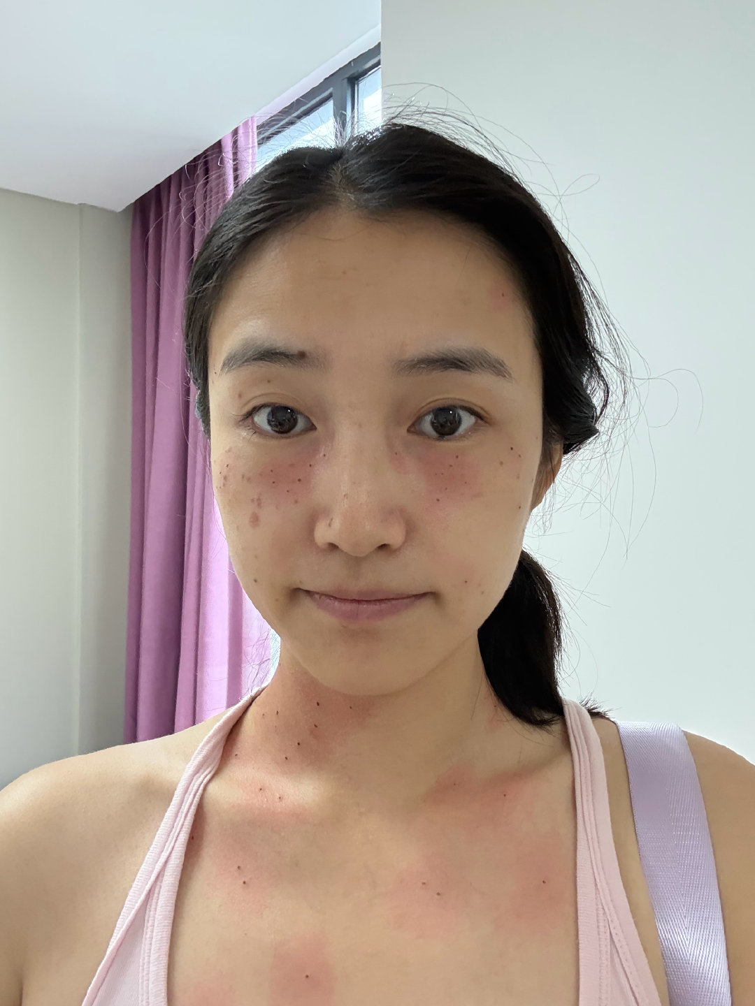 在医院挂皮肤科 点了 80 多下扁平疣
可以刷医保卡 ​