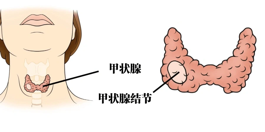 体检有甲状腺结节，还可以买保险吗?