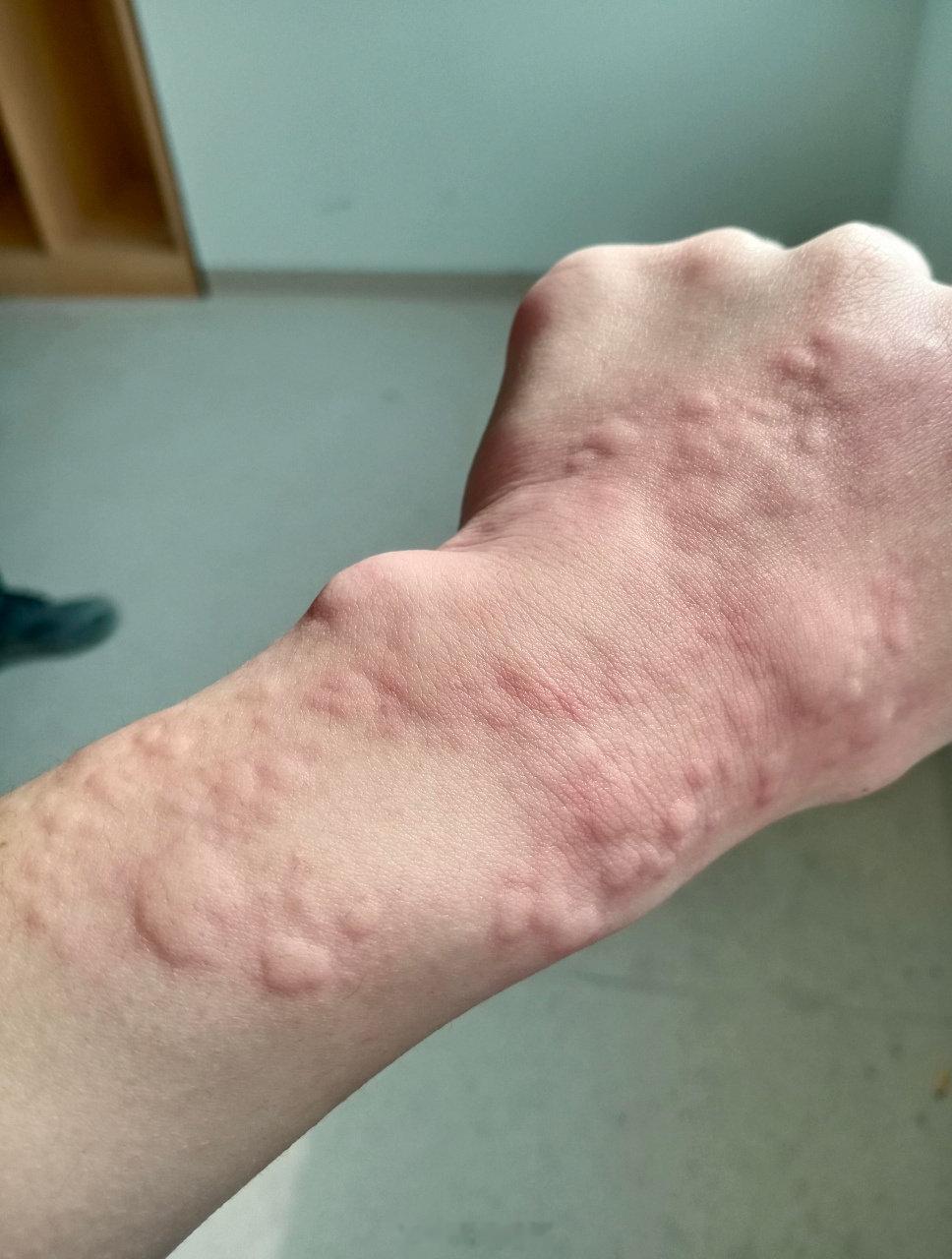 过敏了，抗过敏药怎么选？#微博科学抗敏行动#

过敏时身体会释放一种叫"组胺"的物质，引起打喷嚏、流鼻涕、起疹子发痒等症状。抗组胺药的作用就是阻断组胺，缓解这些症状。

这类药分三代，

第一代：代表药有马来酸氯苯那敏、苯海拉明、赛庚啶、异丙嗪。

优点是便宜，止痒、止喷嚏流涕效果直接。缺点是容易进入大脑，吃完犯困、头晕、没精神，还会口干。服药期间不能开车、高空作业、操作机器。异丙嗪2岁以下儿童禁用，可能引起呼吸抑制；其他第一代药给孩子用也要谨慎，有更安全的选择时优先用第二代。
现在第一代药主要用于晚上，比如痒得睡不着时吃一粒，既能止痒又能帮助入睡。

第二代：代表药有氯雷他定、西替利嗪、依巴斯汀
这是目前最常用的。不容易犯困，白天吃了不影响工作学习，一天一次，方便。儿童剂型成熟，西替利嗪1岁以上婴儿可用，氯雷他定一般2岁以上可用。

慢性荨麻疹、过敏性鼻炎这类需要长期用药的，或白天需要保持清醒的，首选这一代。常规剂量下安全性好，但老年人、严重心律失常或肝功能不全者用前需咨询医生。...