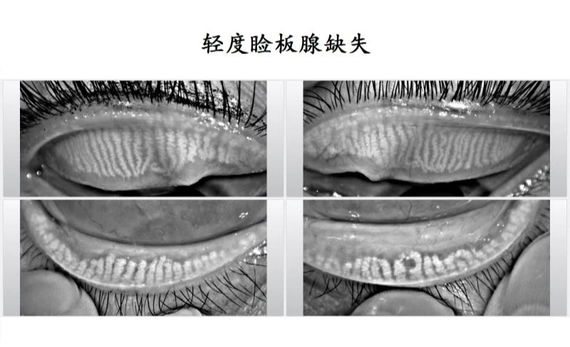 缺失的睑板腺是不能长出来的！