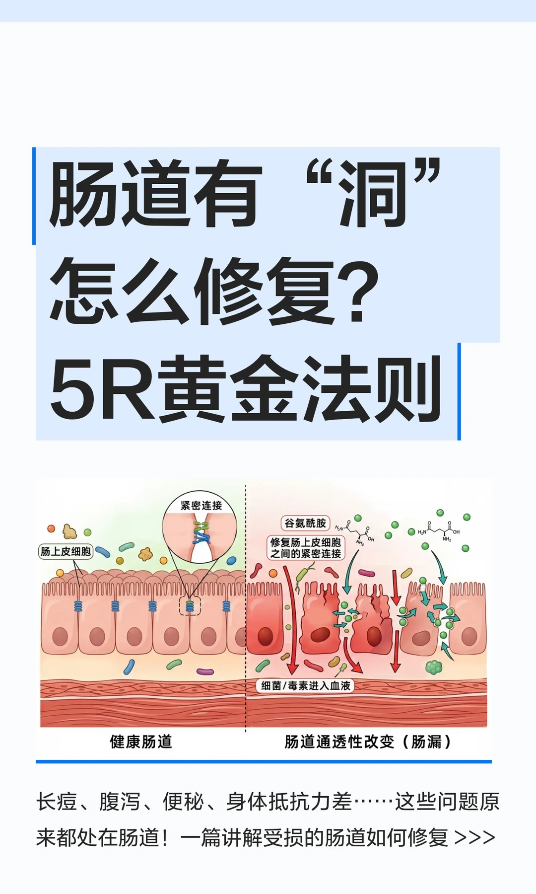长痘过敏便秘腹泻看过来！肠道5R修复法则