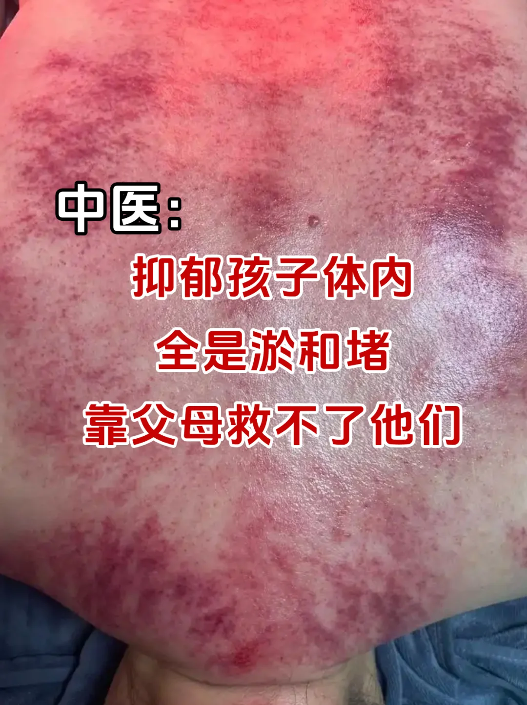 中医：抑郁孩子体内全是淤堵，靠父母救不了