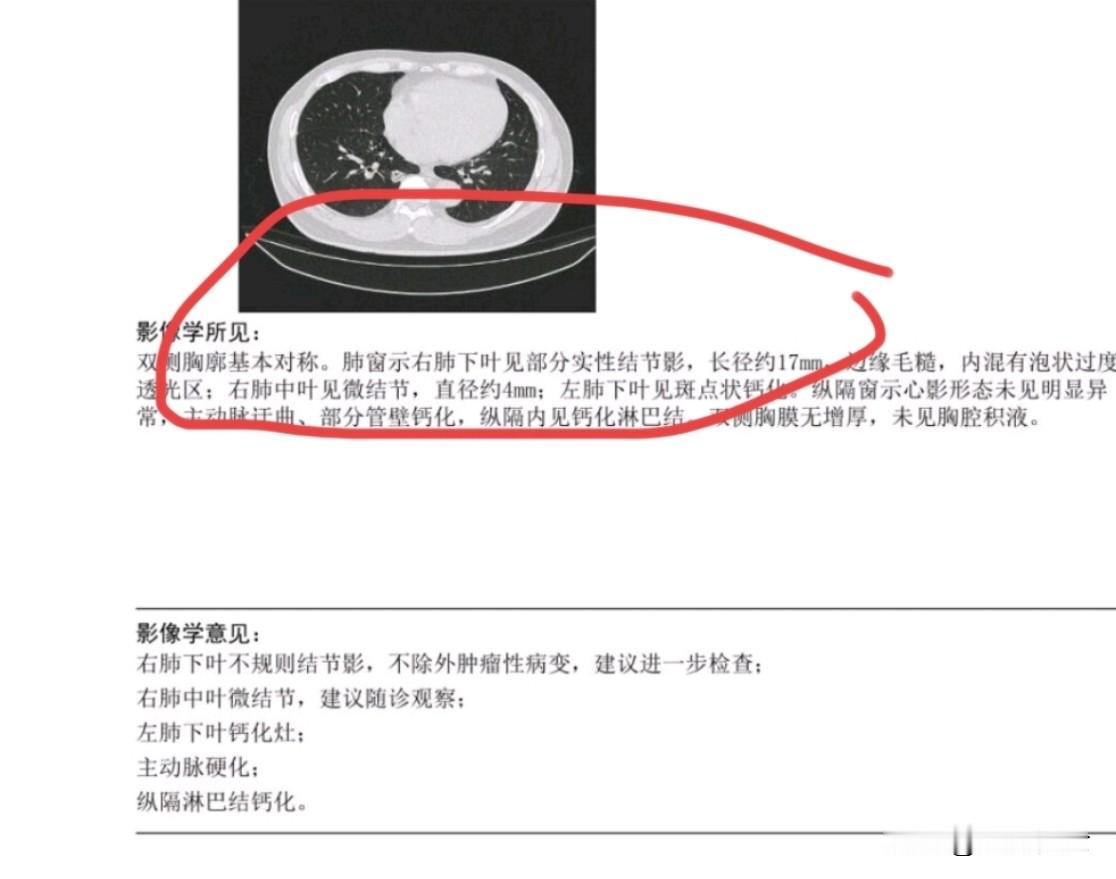 作者加速成长计划一位在天津工作的六十岁男士体检发现右肺下叶有一个十七毫米的混合密度磨玻璃结节，实性成分多，首先考虑恶性肿瘤。这种情况可直接住院系统检查，争取手术。他在我这里住院检查后无手术禁忌，顺利完成手术，病理证实为浸润性肺腺癌。通过查体发现早期肺癌，及时手术，可以获得很好的治疗效果。