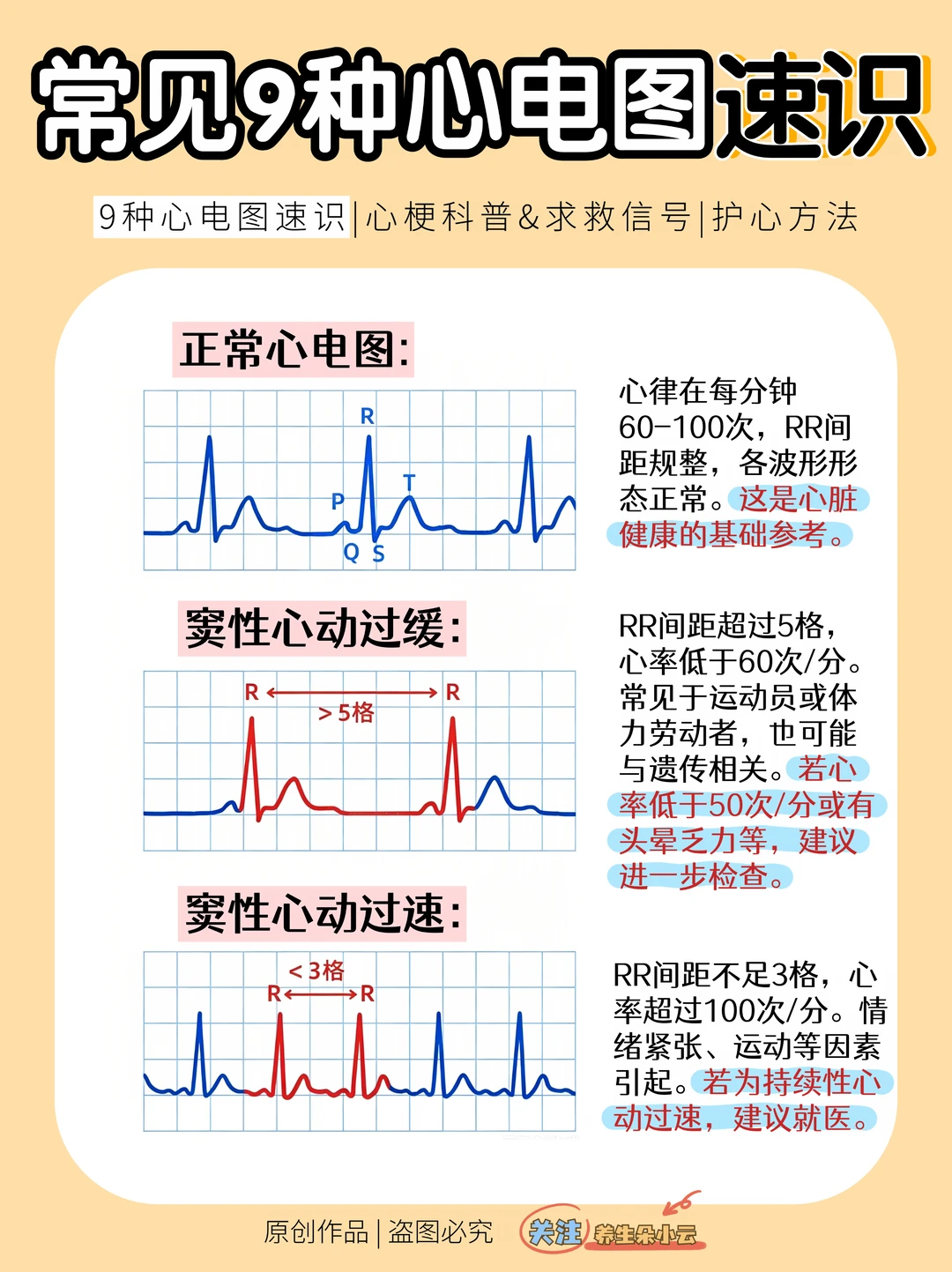 9种心电图速识🆘不可忽视的心梗信号