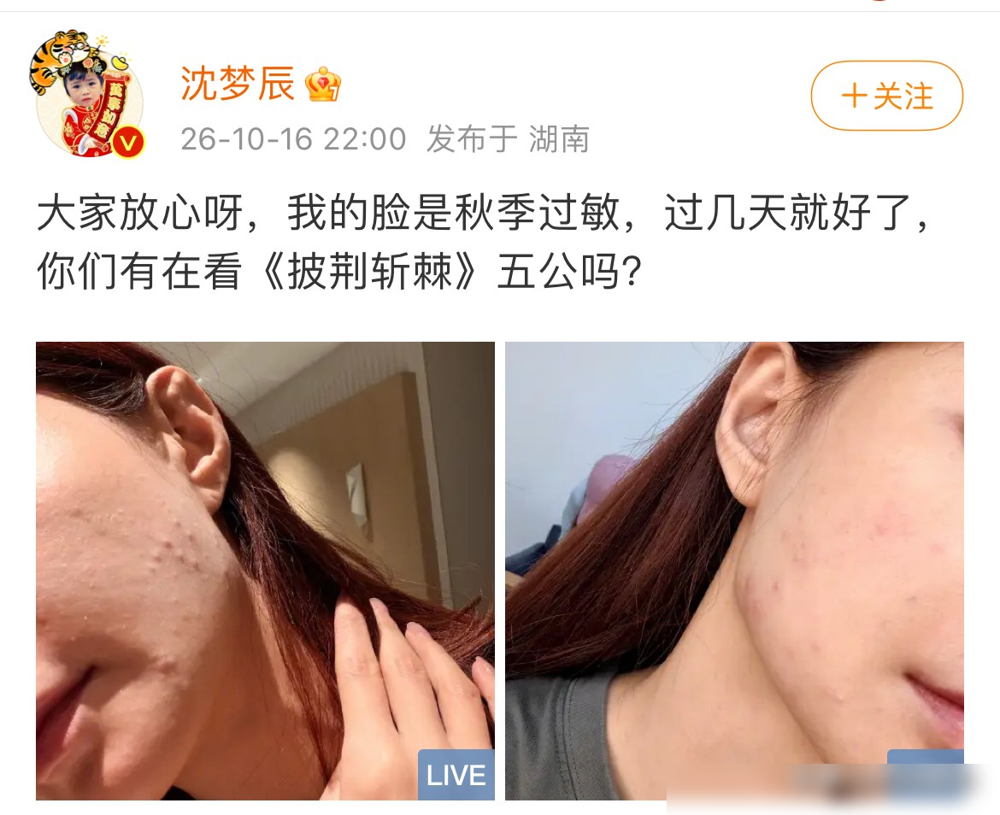 沈梦辰那张脸，镜头怼上去的瞬间，粉底下全是凸起的红疙瘩。
遮瑕盖了三层，还是盖不住泛红。她自己在社交平台说是秋天过敏，可网友翻出她《真正男子汉》里的素颜，皮肤黑、暗沉、痘印明显，跟台上那个白到发光的女明星压根不像一个人。
她直播试过只画半张脸，另外半张素颜。对比一出来，评论区全炸了，说化妆师该加
