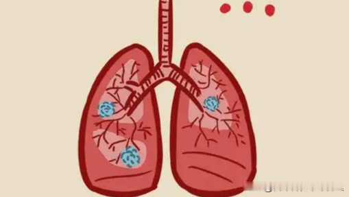 钟南山团队最新研究刷新肺结节认知 非吸烟人群成肺癌防控新重点
2026年8月，钟南山团队在国际期刊发布一项覆盖全国16个省份、23家医院的多中心随访研究，通过对一万余名体检偶然发现肺结节的人群开展2至3年跟踪，揭示了我国当前肺结节与肺癌发病的全新特征，为公众肺部健康筛查观念更新提供了重要依据。
本次