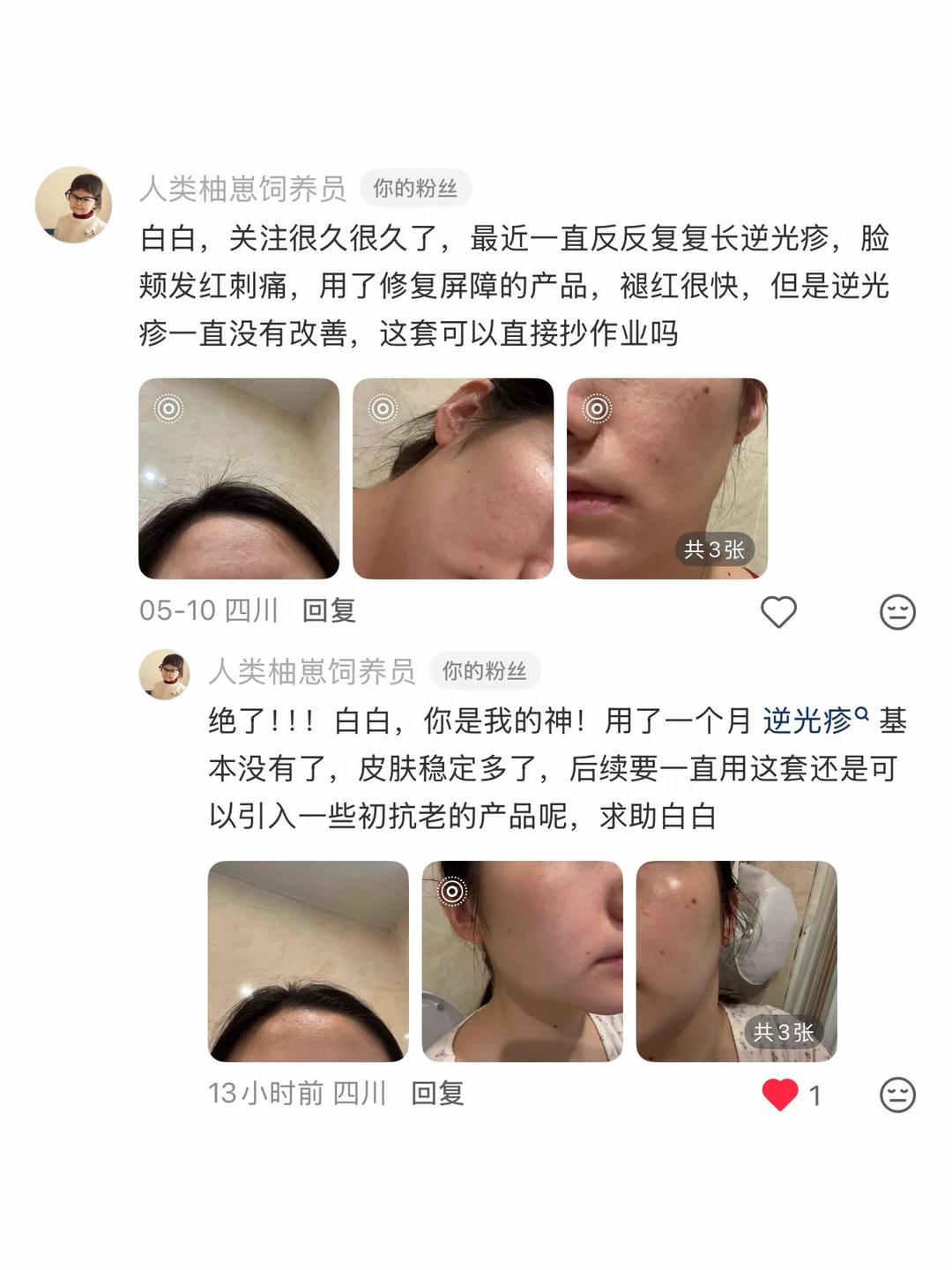 全网最强修复逆光疹的方法！不好用骂死我！