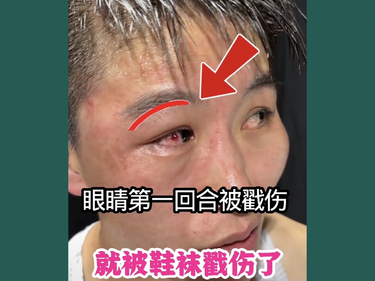 王聪说：第一回合，自己的眼睛就被席尔瓦戳伤了，刚开始视力有点模糊，后面才恢复看得清的。从王聪的眼睛来看，确实被戳伤了。