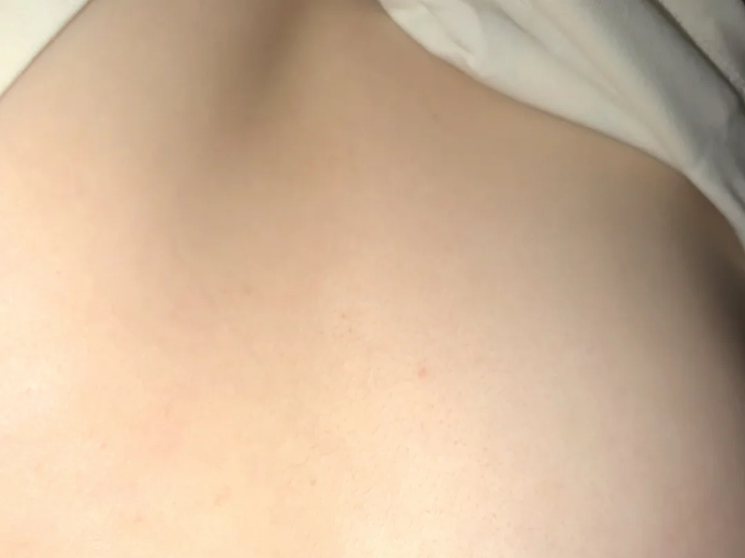前胸后背长痘的都去试试这个方法！！！！！！！！