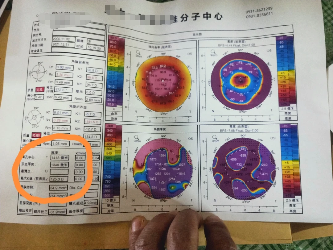 超过1000的角膜厚度你见过吗？