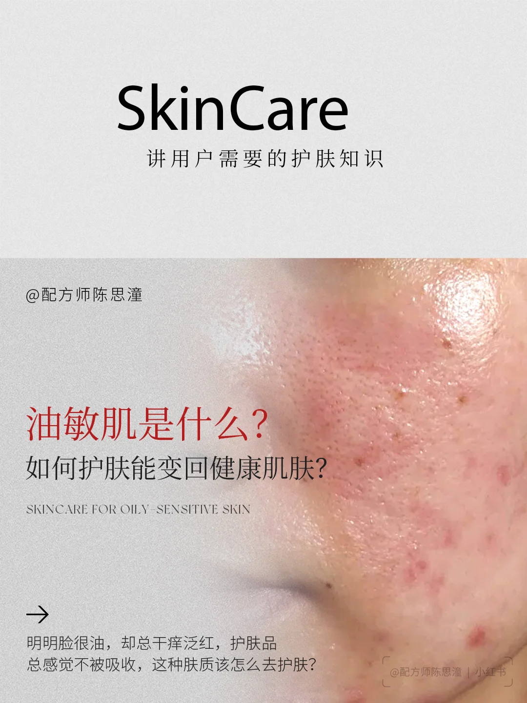 护肤知识｜油敏肌为什么 “又油又敏感”？