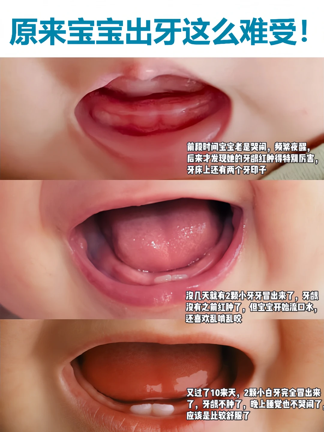 宝宝出牙顺序➕症状➕护理，新手爸妈需知道