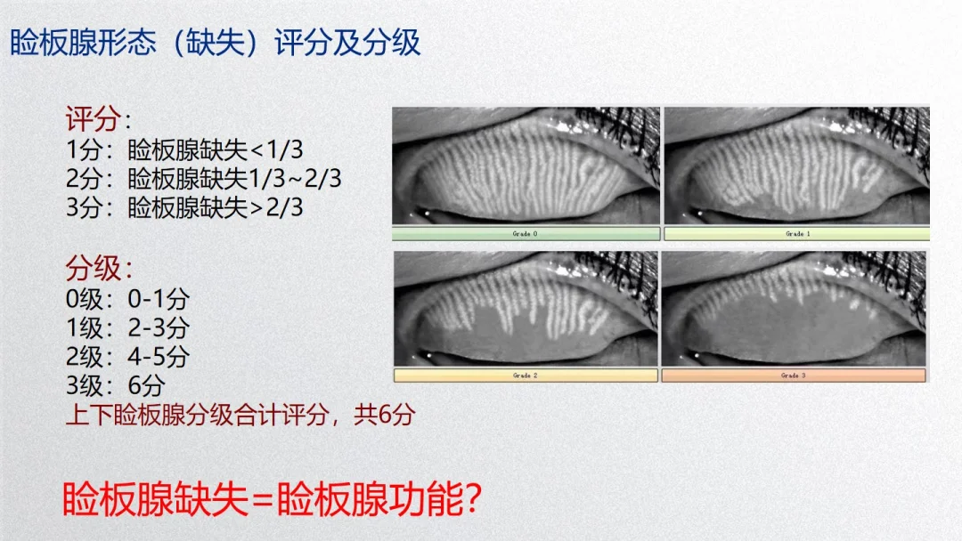 睑板腺缺失怎么评分分级？