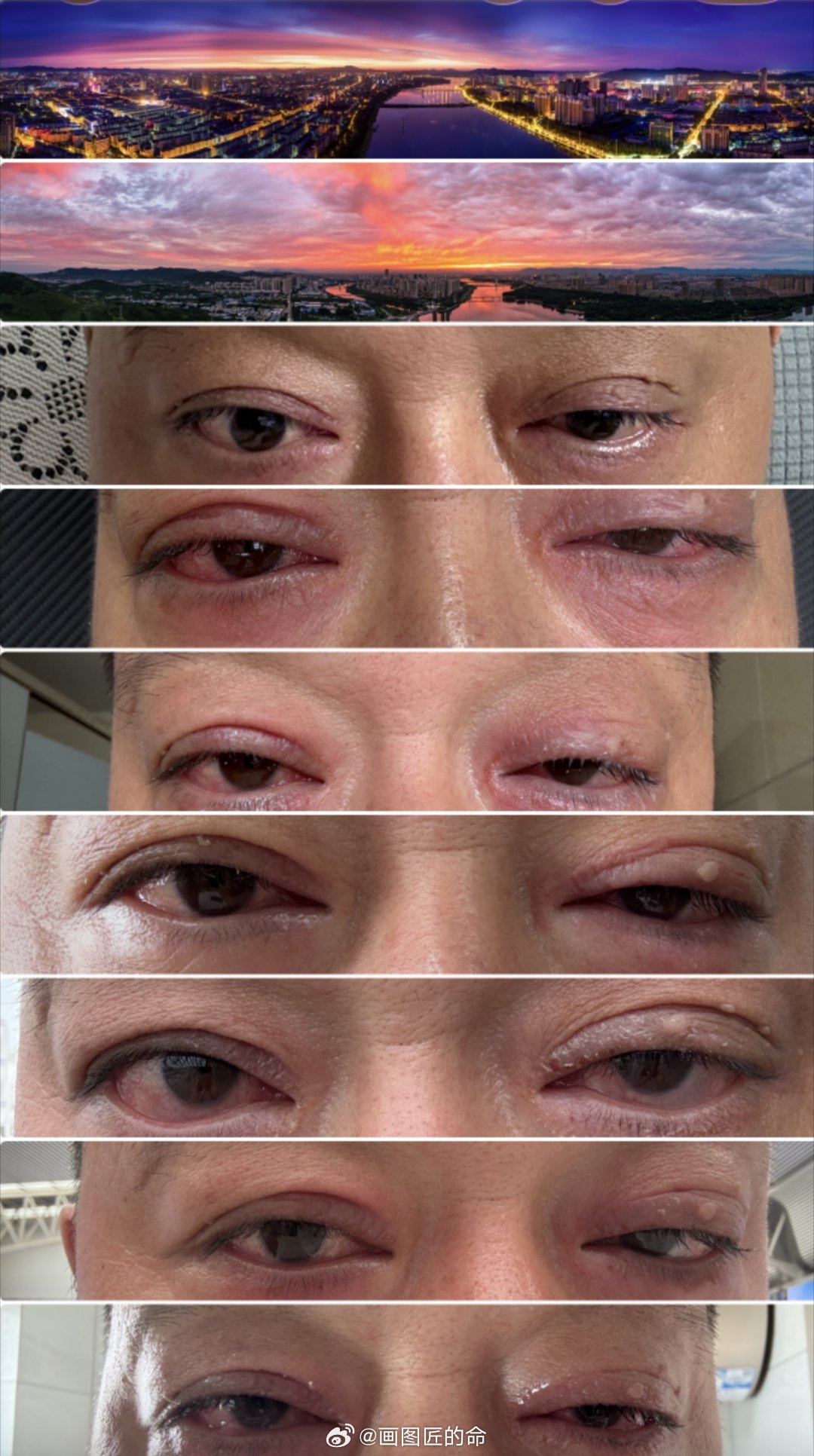 致那些曾经过往的青春。16年前诊断为rpc并发巩膜炎，今年大面积爆发，巩膜炎，眼周组织炎症反复纠缠。还好，没有低头，没有崩溃，勇敢面对。罕见病并不可怕，这几个月的治疗，让我学到了很多知识，也有了应对的信心。和不良嗜好说拜拜，跟病魔抗争到底。 ​