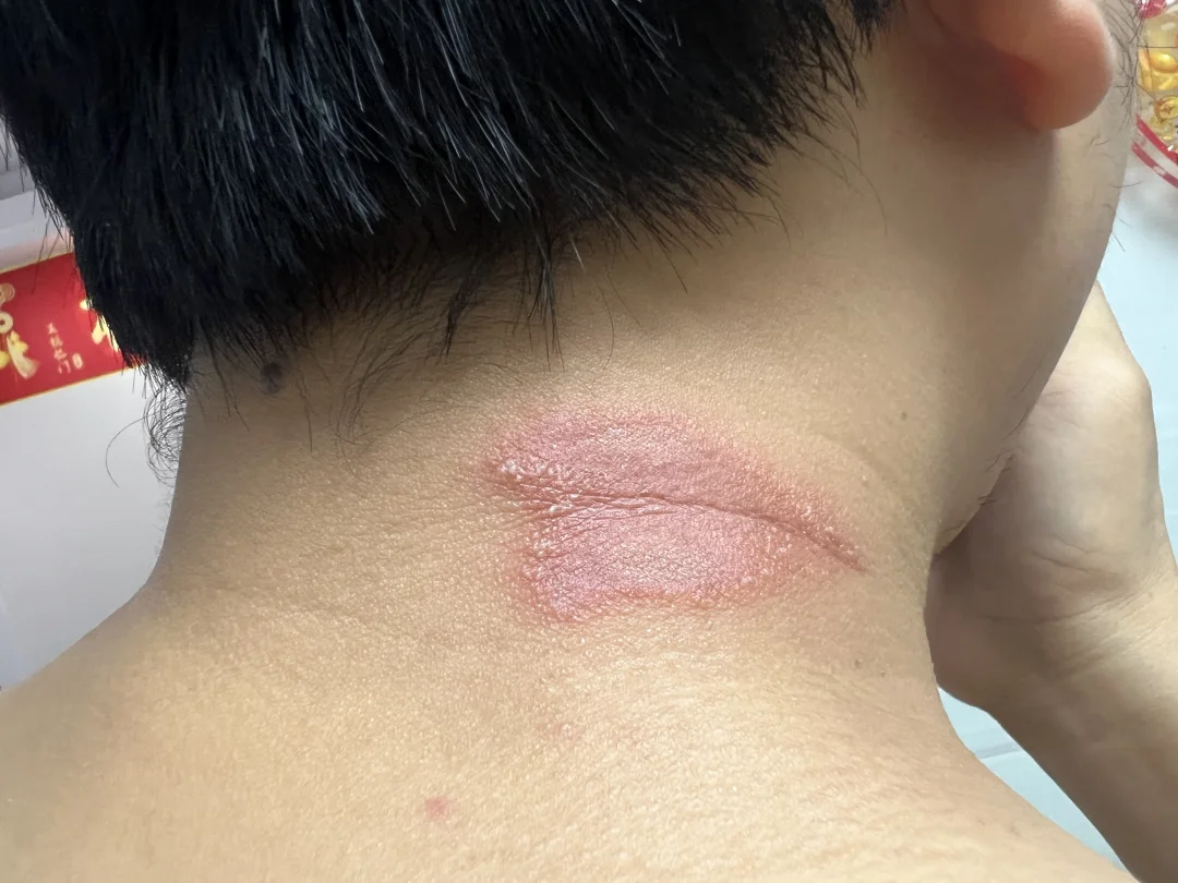 脖子上长了这个是什么？