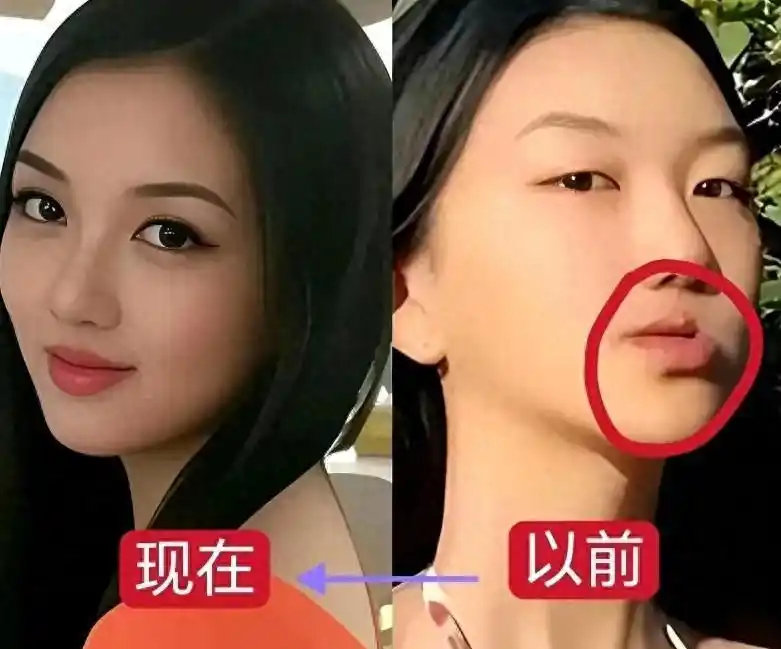 #李嫣几乎看不见唇腭裂修复痕迹#
李嫣从“兔唇”女孩到自信绽放，历经四次修复手术终蜕变。王菲与李亚鹏不仅用爱与财富守护女儿，更创立嫣然天使基金会，帮助数千名同样困境的孩子重获新生。她的画作义卖百万，叛逆与才华并存，活成了自己的光。 ​