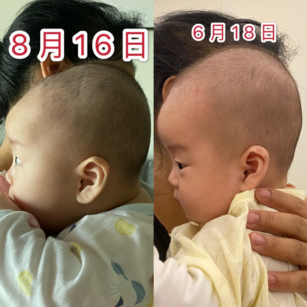 干货｜问题头型如何睡出小圆头❓
