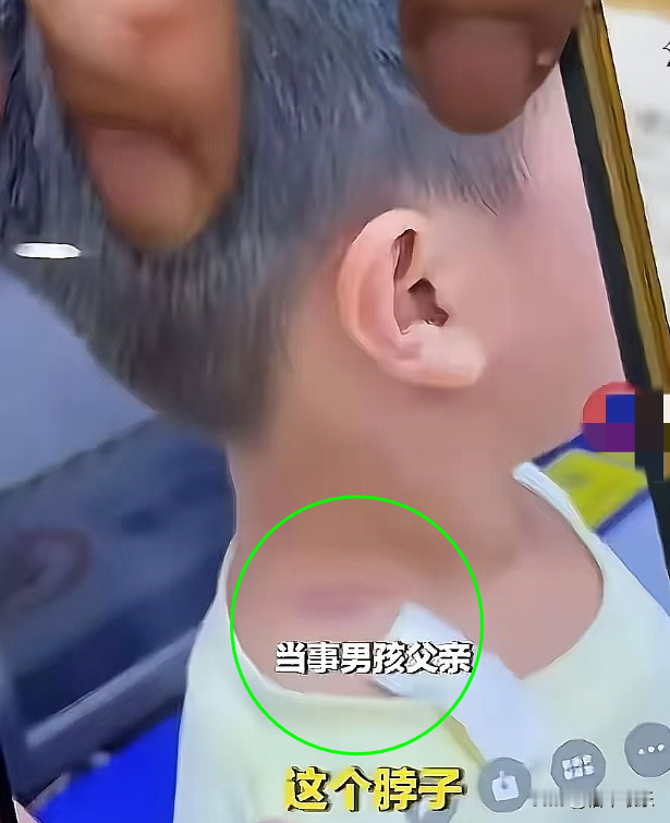 长沙摸臀事件里，我始终忘不掉一个细节，那个四岁男孩的脖子上，被勒出了一道淤青。
那道印子不是孩子自己磕的。八月二十六日的长沙一家餐厅，他举着玩具枪，正处在四岁男孩最坐不住的年纪，跑起来横冲直撞，胳膊一带，碰到了邻座福建来的女子小熊（化名）。监控里的画面更像是没收住脚的意外，可在小熊看来，这是故意摸臀