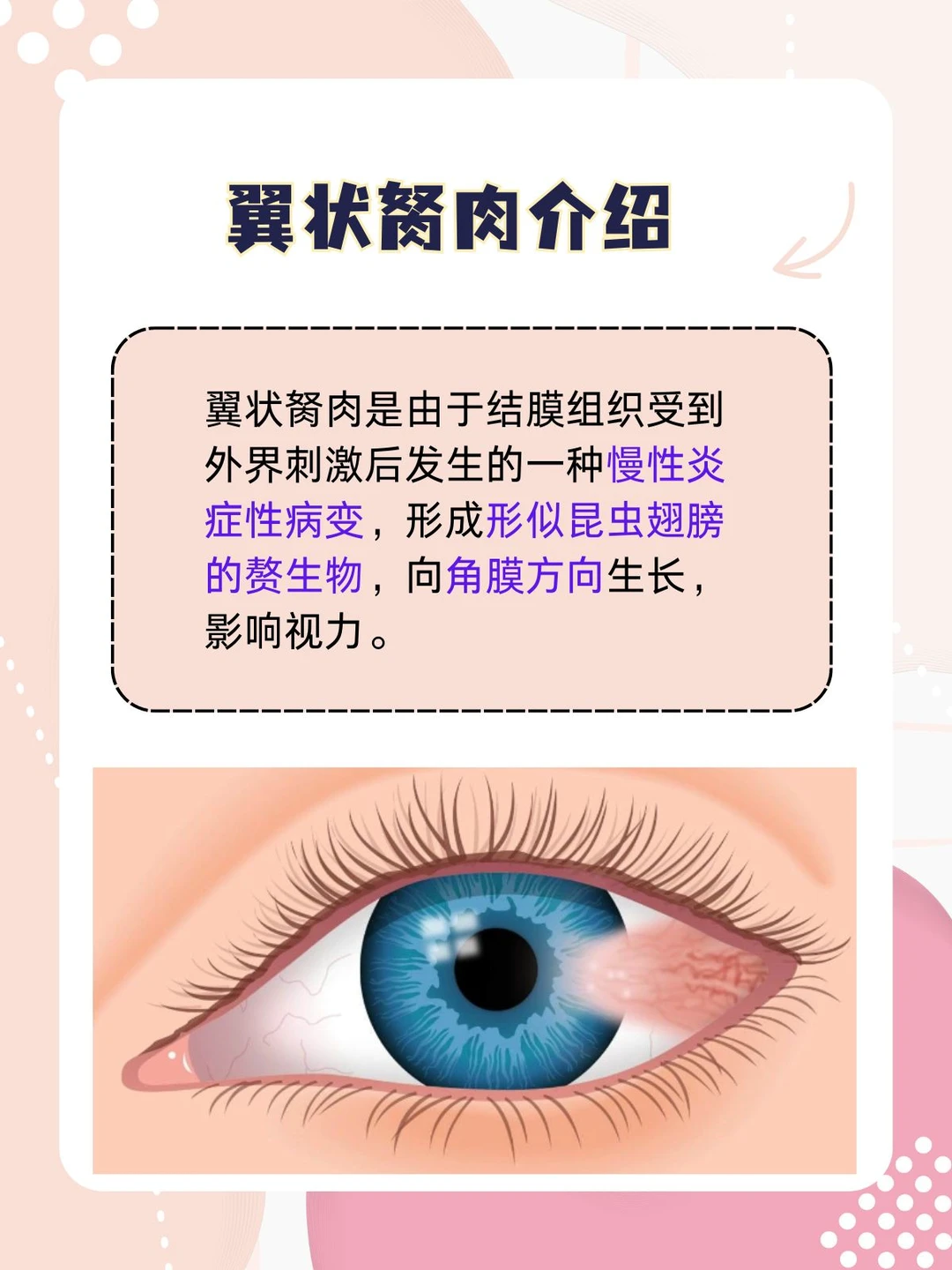 翼状胬肉，一定要手术吗？