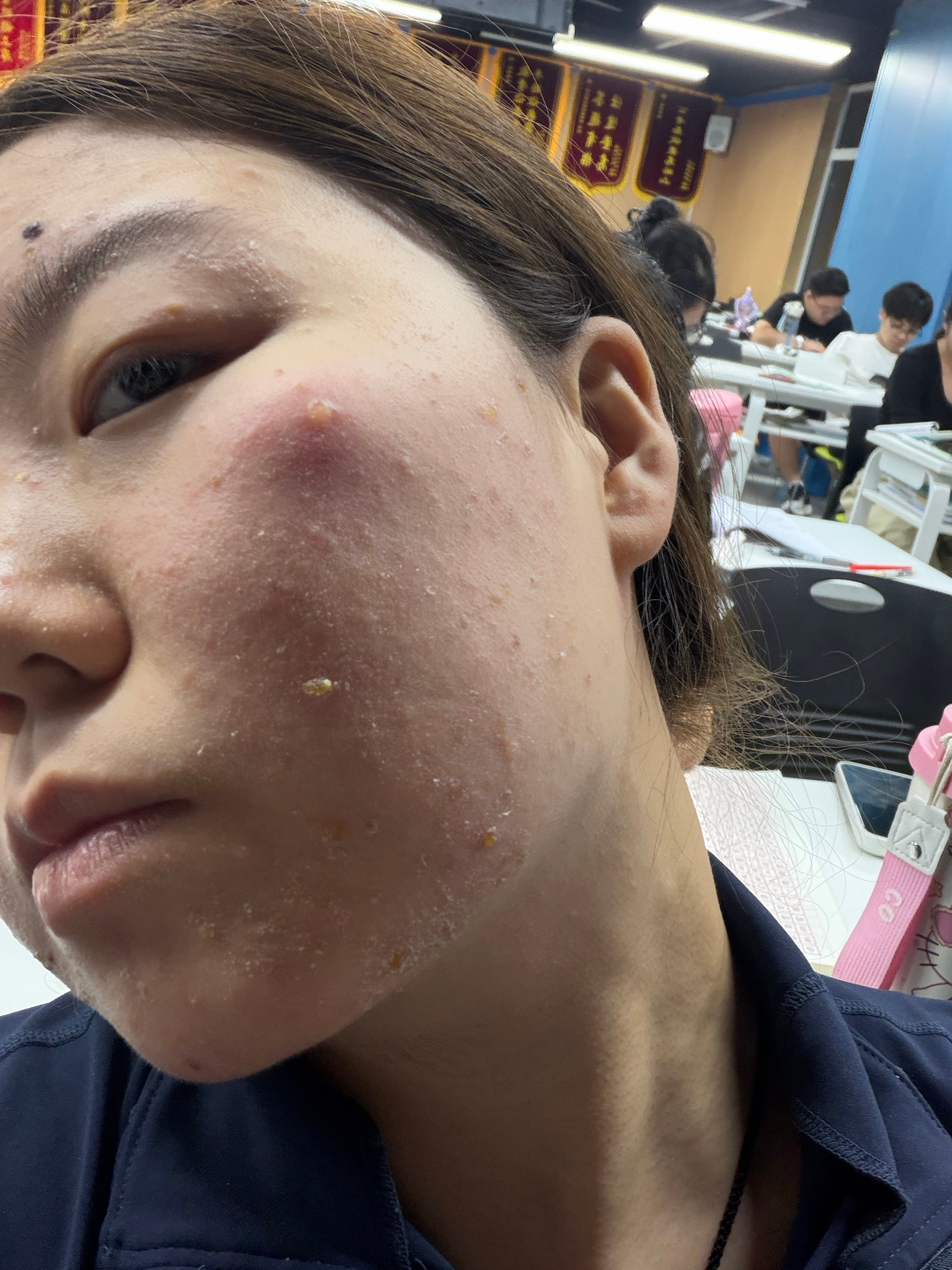 #大水泡##脸起大水泡# 红肿发烫#蚊子包# 
不化妆，就简单水乳，不长痘，打完新冠疫苗后几个月突然有一天睡醒脸上起了一个大水泡，不疼不痒没任何感觉，自己流水7.8次结痂就好了，一直这样，不定期没有规律，起大水泡，到处看病用药，没有好转，两年陆续用了太多药，不知道怎么回事变成小水泡了，但是也 ​
