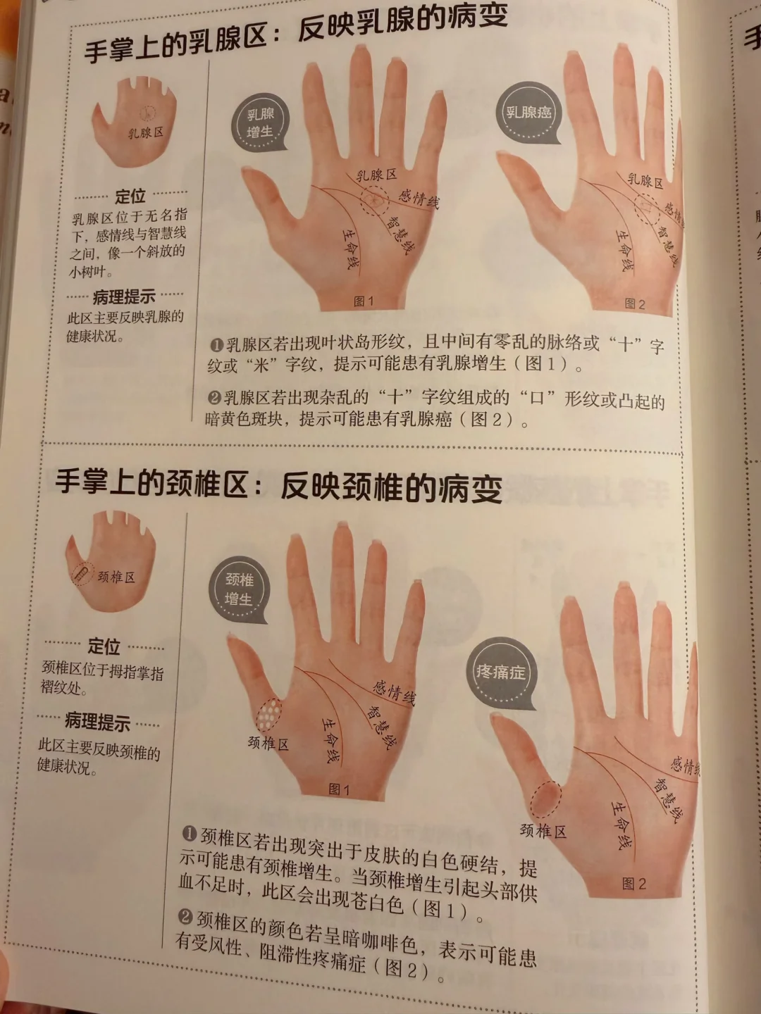 手掌上的乳腺区：反映乳腺的病变