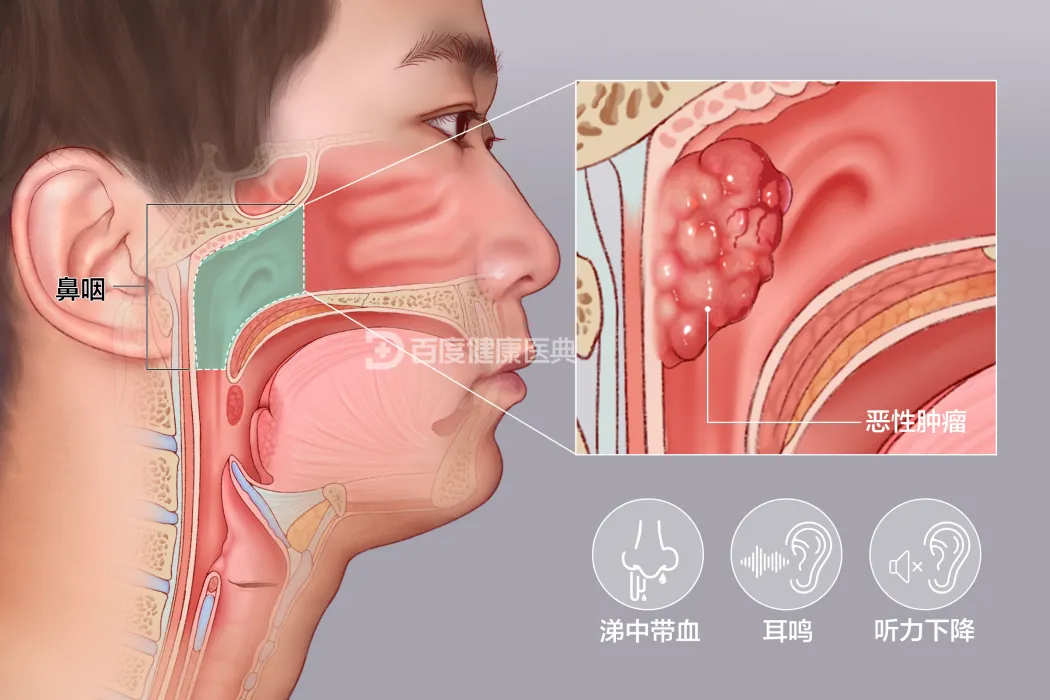 鼻咽癌放疗后为什么会失聪? #鼻咽癌放疗后为何会失聪# 

鼻咽癌放疗后听力下降很常见，通常不是单一原因，而是放射线和化疗药（主要是顺铂）联手造成的。表现以高频听力下降为主——就是高音调的声音先听不清，也可能伴随耳鸣；同时放疗还会让咽鼓管和中耳出问题，导致耳闷、积液，造成另一种传导性听 ​