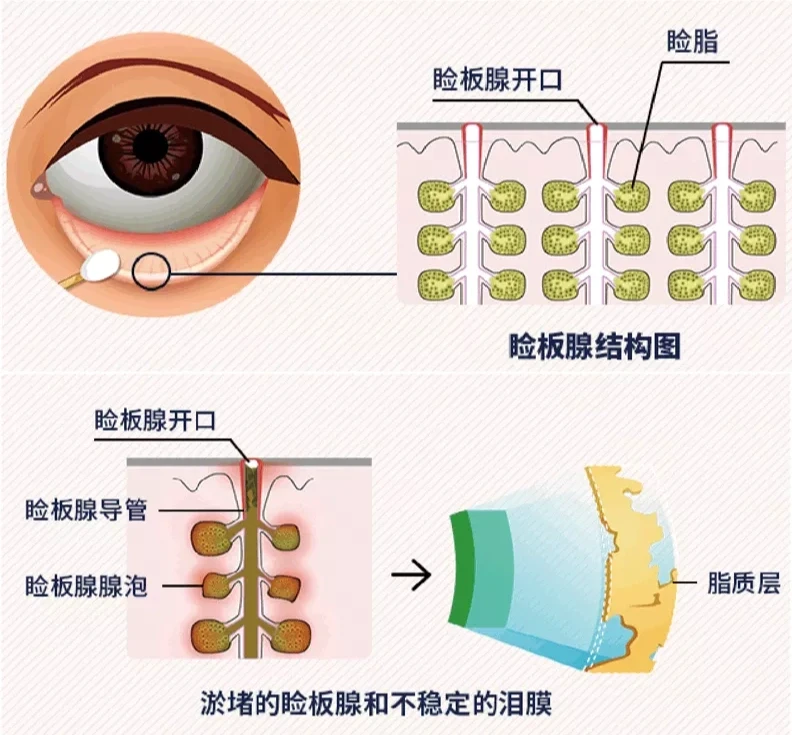 为啥干眼患者需要运动呢