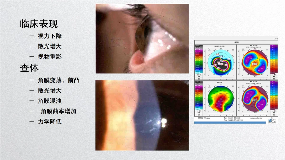 圆锥角膜，为什么会出现？