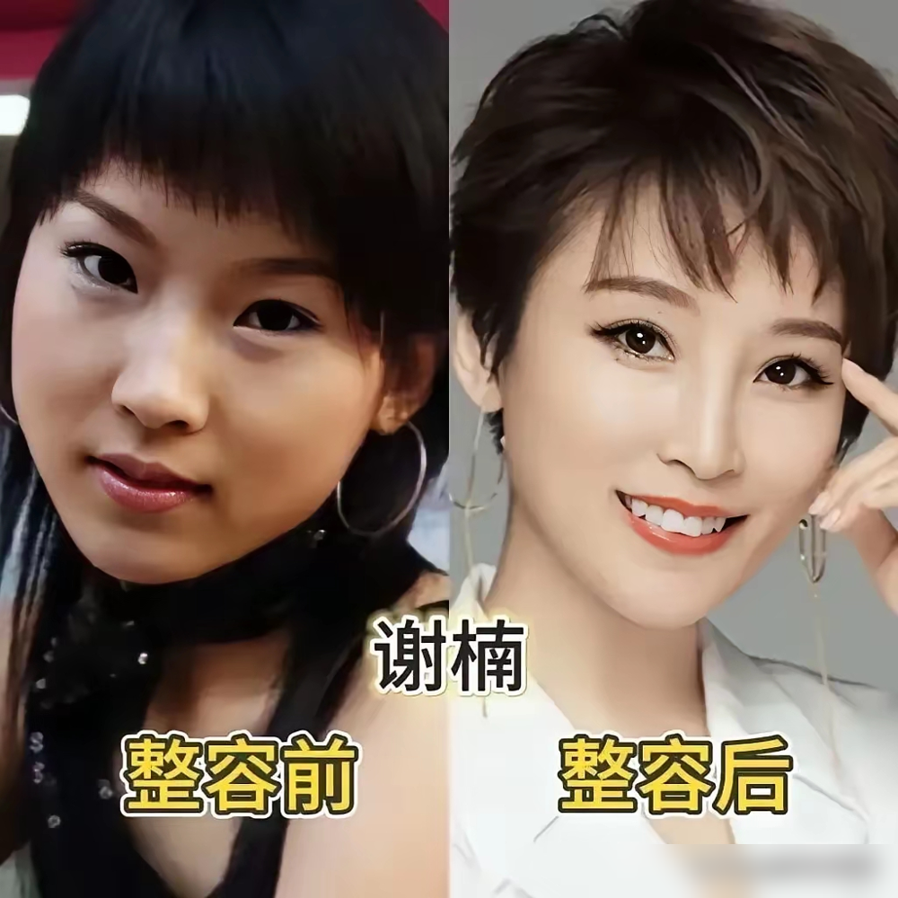 同样被传整容，两人处理方式天差地别！
沈梦辰2015年靠《我是歌手》出圈后，早年选美旧照被扒，宽脸蒜头鼻和现在的精致小脸判若两人，整容传言一飘就是11年。
这么多年她从来没正面大方回应，只早年录综艺玩游戏的时候绕弯子否认，舆论每次都要拉扯半天。
反观熊黛林，直接大大方方承认自己做过医美，不躲不