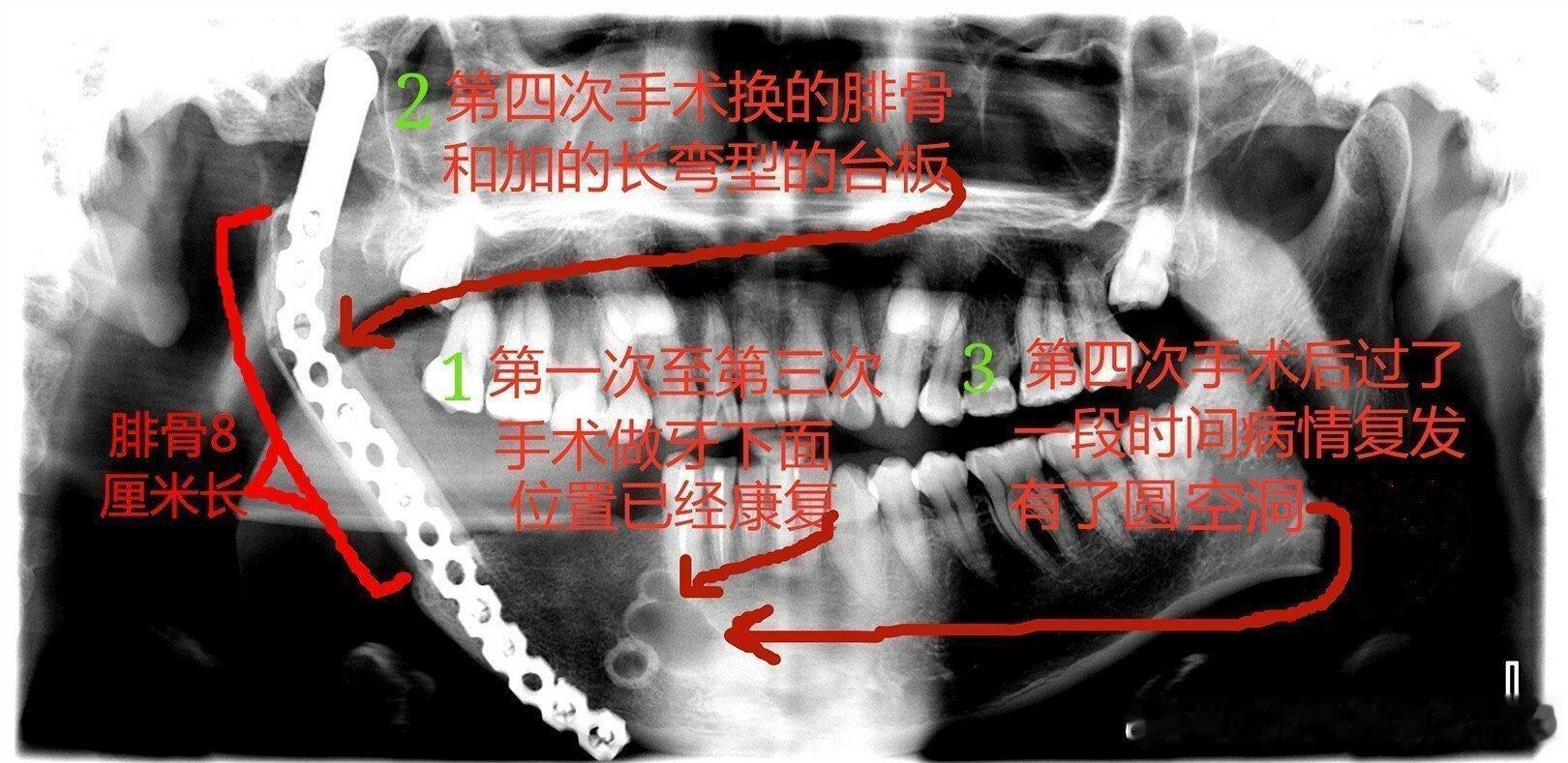 #医保卡提现方式被男的开发出来了#广东省深圳市北京大学深圳医院做的5次手术，第1次至第3次手术做根管治疗和牙下面两个圆空洞位置已经康复没有圆空洞，第4次手术换的腓骨和加的长弯型的台板，过了一段时间第1次至第3次手术位置病情复发有了圆空洞至今未愈，请评论手术和台板固定位置! ​