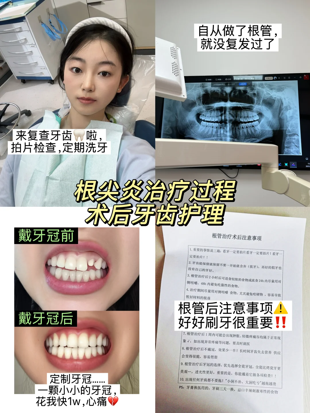 根尖炎已做根管治疗，分享治疗过程+牙齿护理