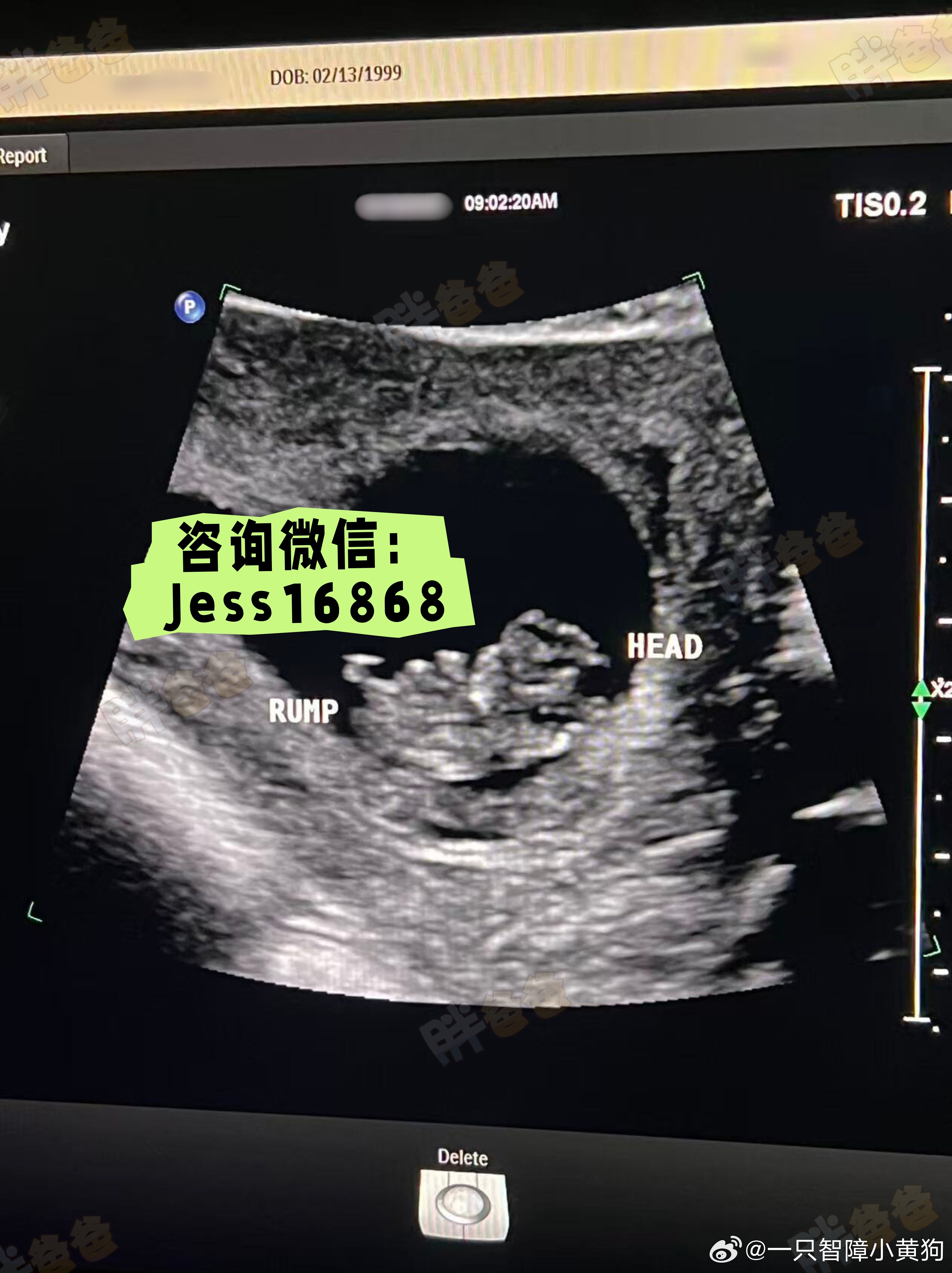 恭喜！终于顺利试管毕业啦✌️
这一路走来其实并不容易，客户历经了两次周期，耐心调理、认真配合，才终于攒下3枚可用P，每一颗都特别珍贵。
之前在匹配[心]mom阶段也经历了一些小曲折，匹配、沟通、调整，来来回回花了不少心思，好在最后终于遇到了各方面都很合适、状态也超棒的TA。
从移植到顺利好孕 ​