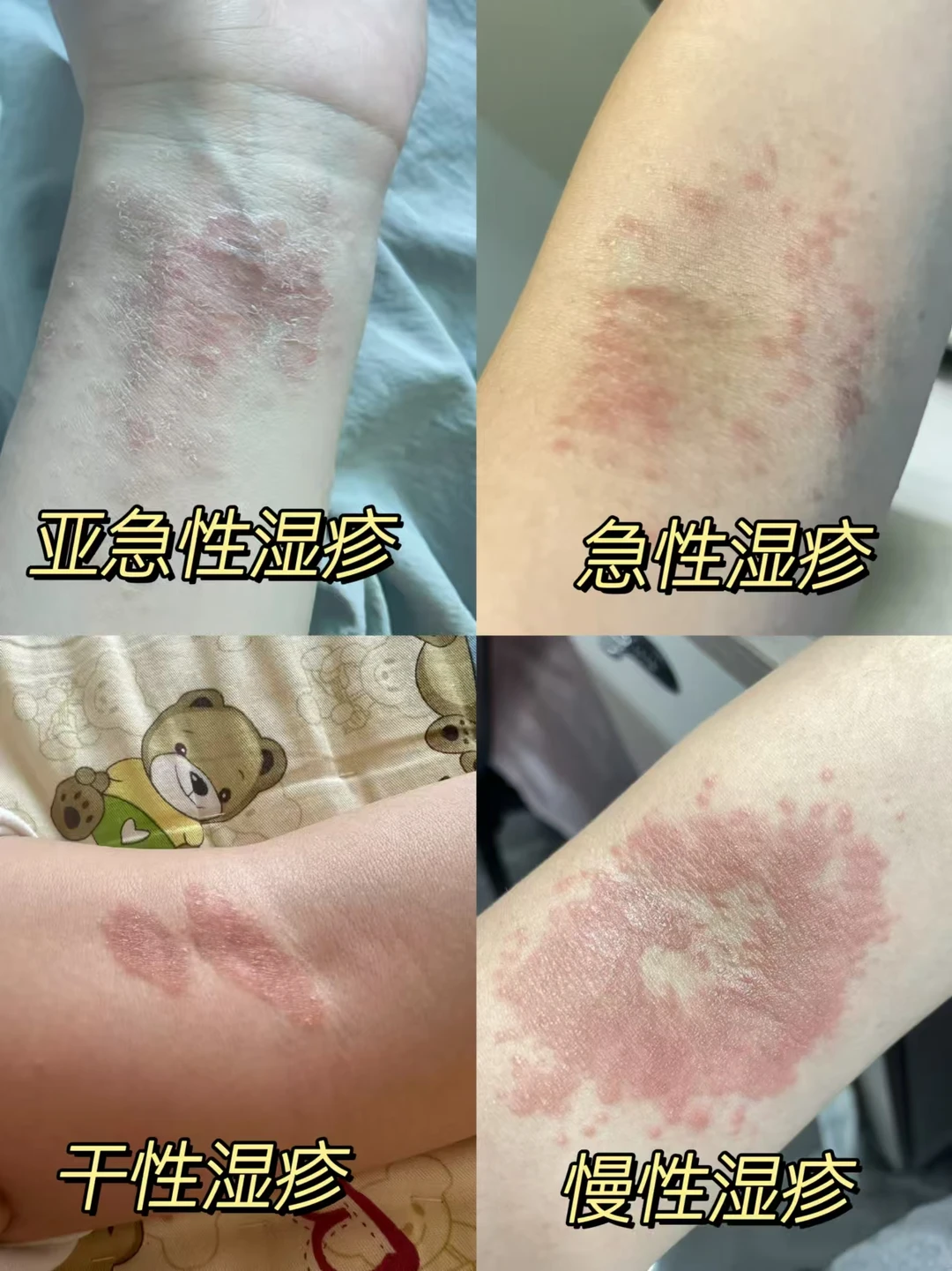 湿疹反复速进！教你如何正确护理