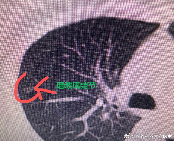 我最近发现，不少肺多发结节朋友，一到门诊就急着想把所有结节都切掉，但该...
