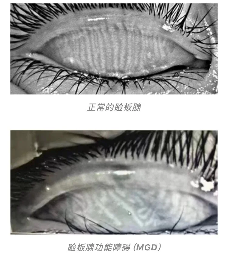 干眼还能用近视手术吗？