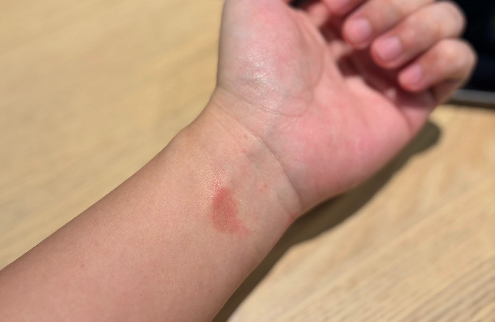 看来 Apple Watch 要停戴一段时间了[泪奔] ​