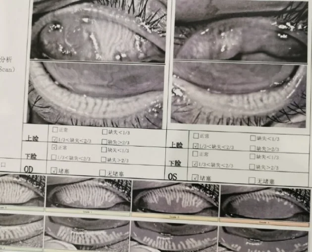 为什么睑板腺会缺失？