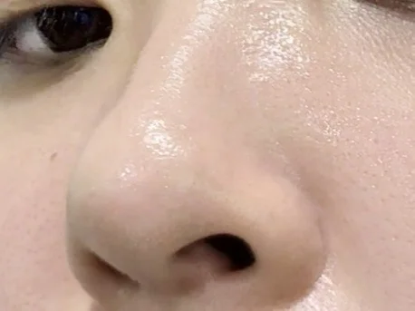 无痛挤黑头的感觉太爽了