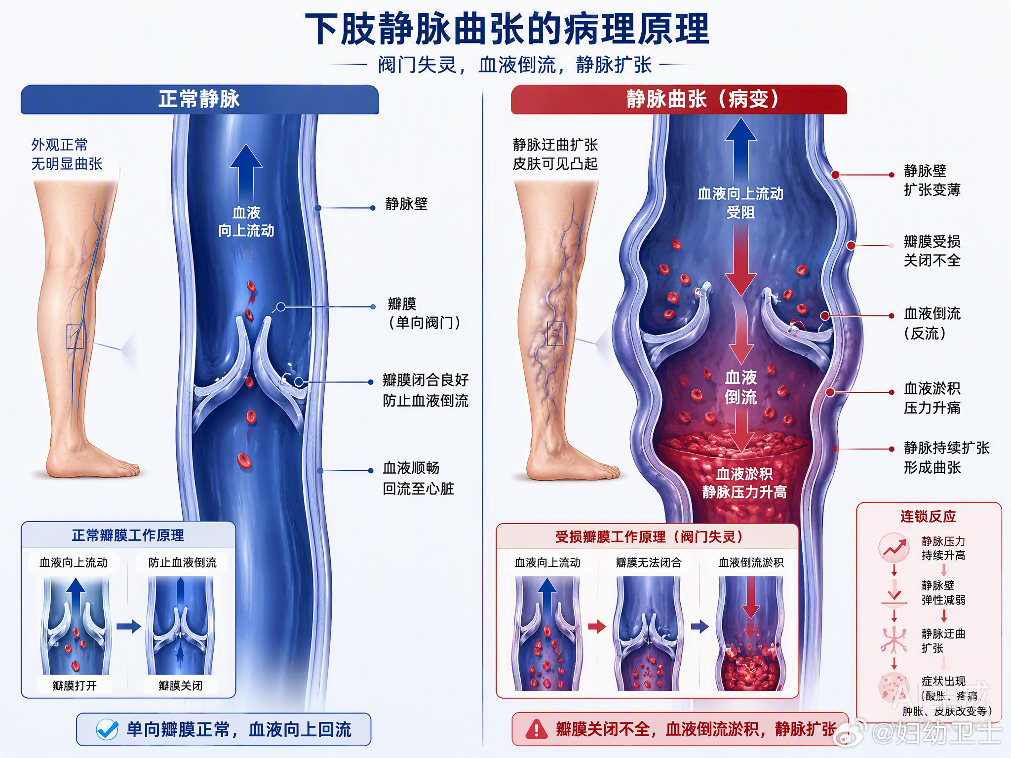 腿上那几根“蚯蚓”不痛不痒，很多人就真以为只是美观问题。南京李阿姨拖了8年，从青筋凸起熬到皮肤发黑、破溃流脓，确诊时已经是严重的“老烂腿”。

静脉曲张其实是血管里的单向阀门坏了，血液倒流淤积，把静脉压得越来越高。早期可能只是酸胀、沉重，但如果不干预，皮肤会缺氧变硬，最后轻轻一碰就 ​
