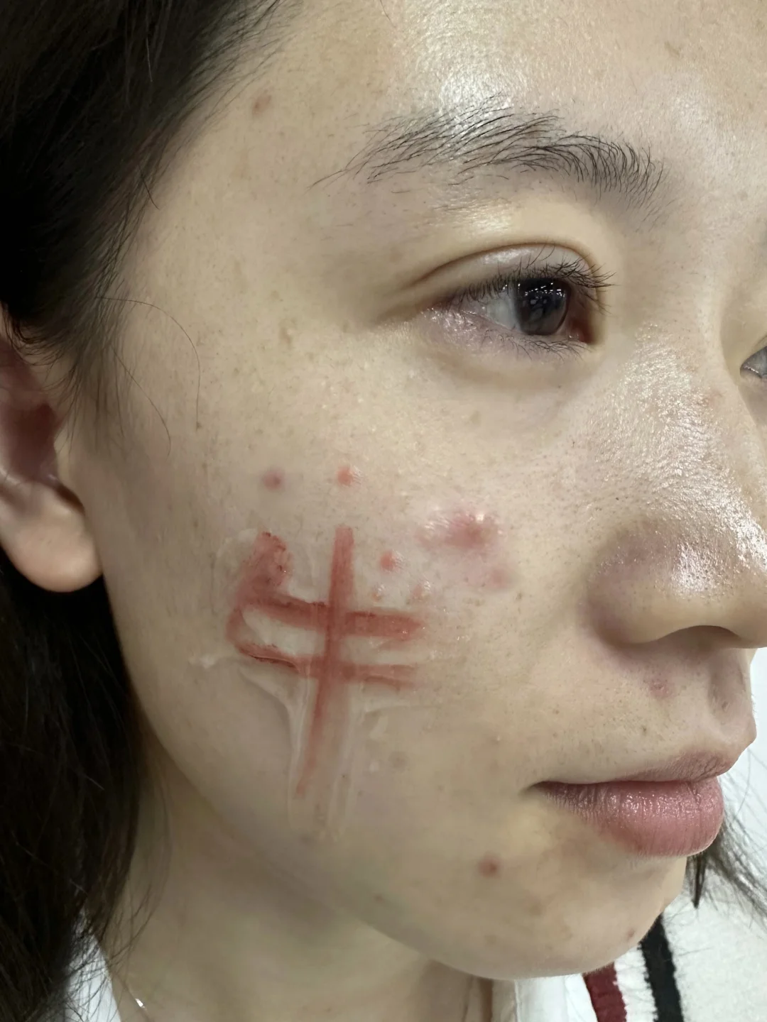 希望所有有痘印姐妹都能刷到！不删！