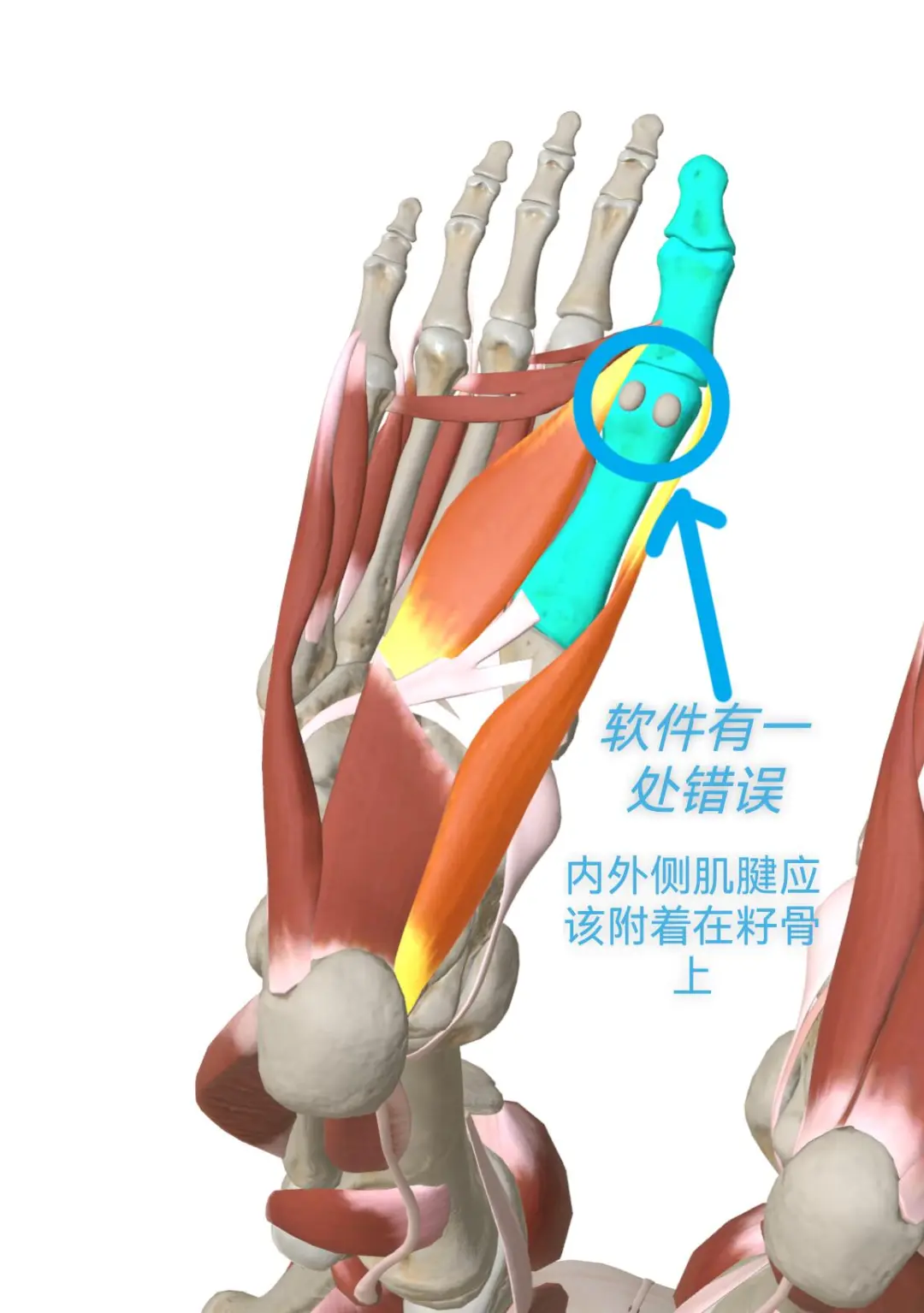 𧿹外翻人群中，女性的比例是男性10倍，主要与激素和关节松弛度有关，遗传现象也很
