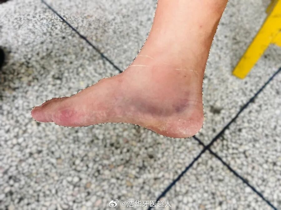 （踝关节扭伤）若早期处理不当（如未充分制动、过早负重）或损伤较重，常会...