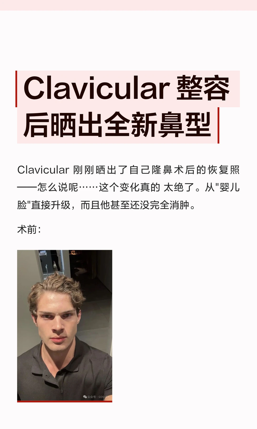 Clavicular 整容后晒出全新鼻型