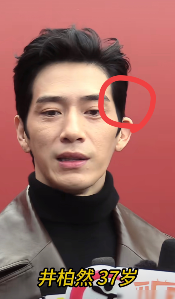 居然有人催井柏然整脸，还劝他别结婚？
最近有人揪着他的长相挑错，说太阳穴凹陷是必须整的缺陷，还扯到他女友，劝俩人别结婚，免得缺陷遗传。
井柏然前几天直播刚回应，连续六个月高强度拍戏睡不好，就是年纪大了皮松，压根没整过。从2015年到现在，他每次回应口径都一致，态度坦然得很。
浙四院的整形医生也