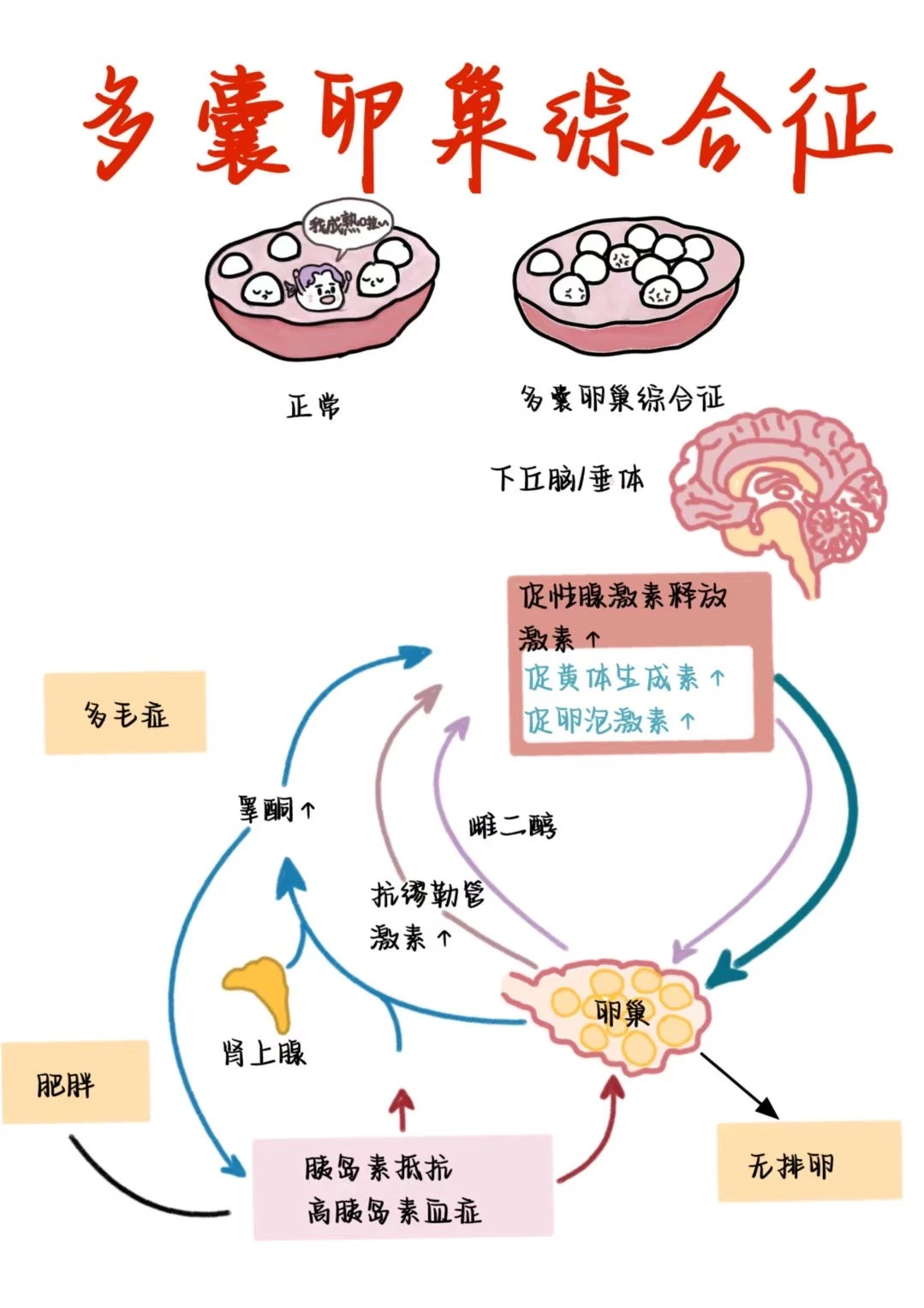 医学生笔记——多囊卵巢综合征