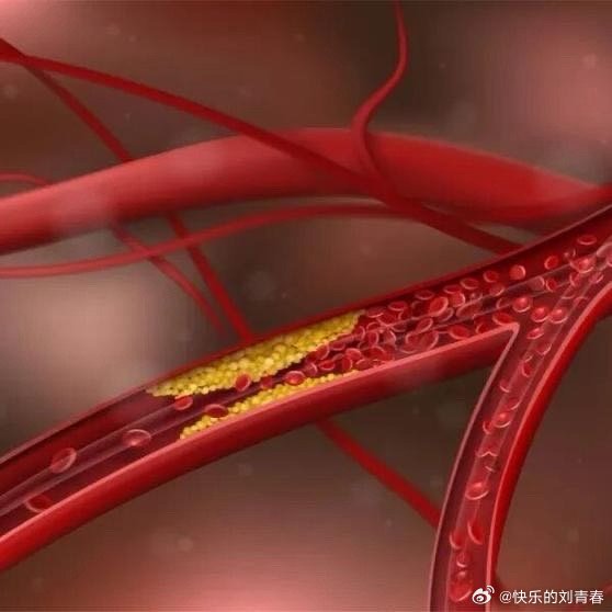《停止做这4件事，血管就能老得慢一点》同龄人中，有的人血管壁光滑，有的可能早早出现动脉粥样硬化斑块、血管狭窄，甚至血管闭塞等症状。 ​