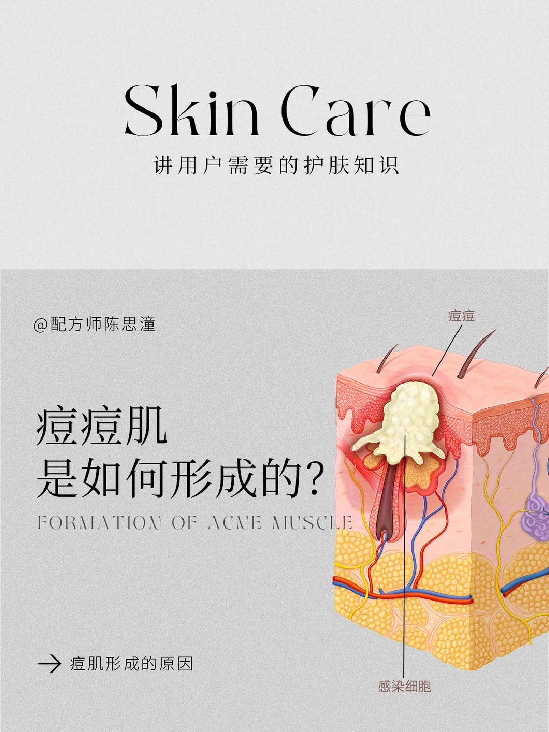 护肤知识｜痘痘肌是如何形成的？分类➕成因