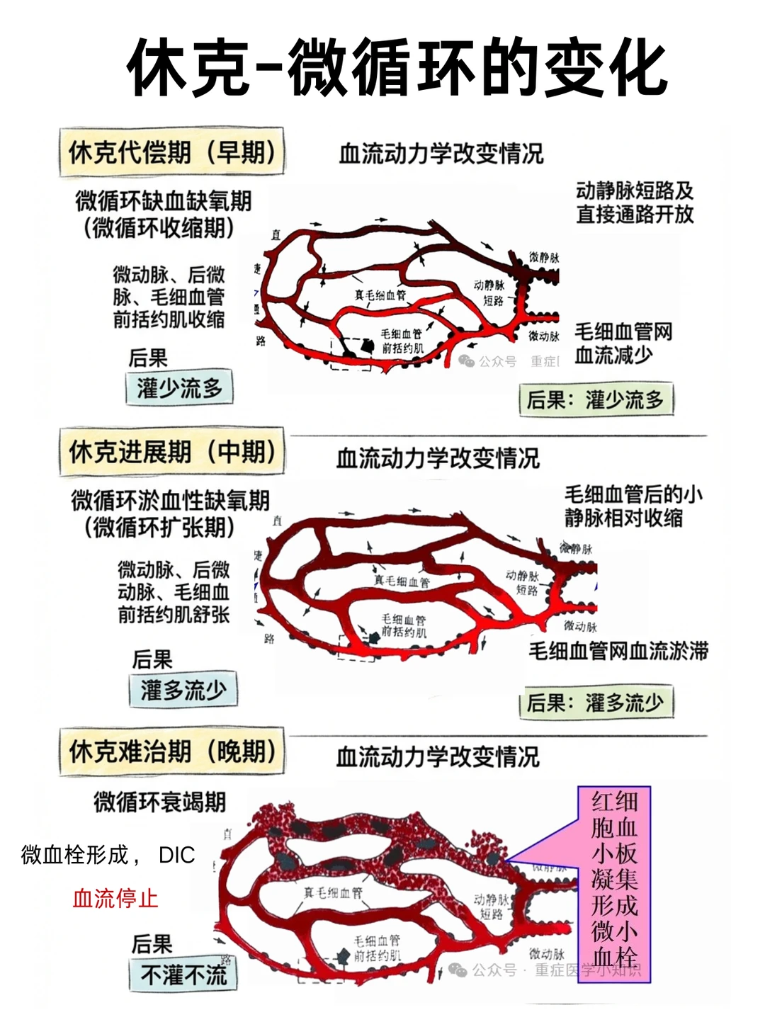 阿虎医考外科学笔记‼️休克-微循环的变化